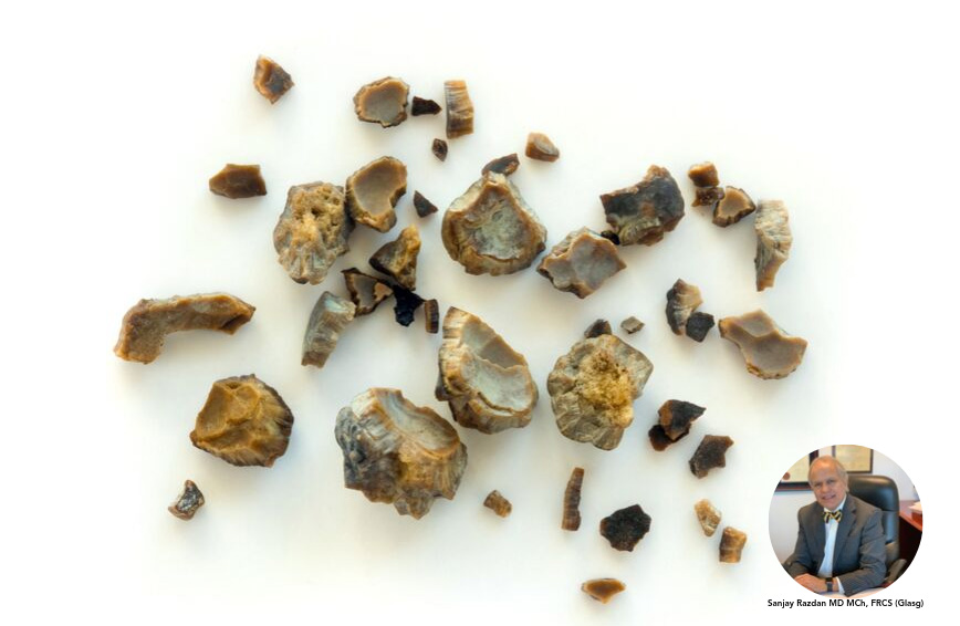 best kidney stone removal