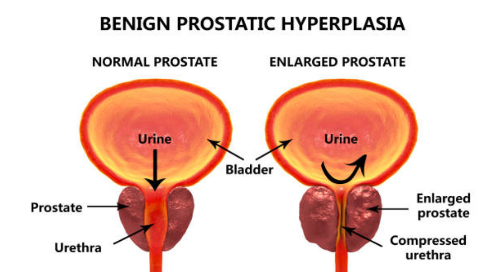 prostata tumor symptome