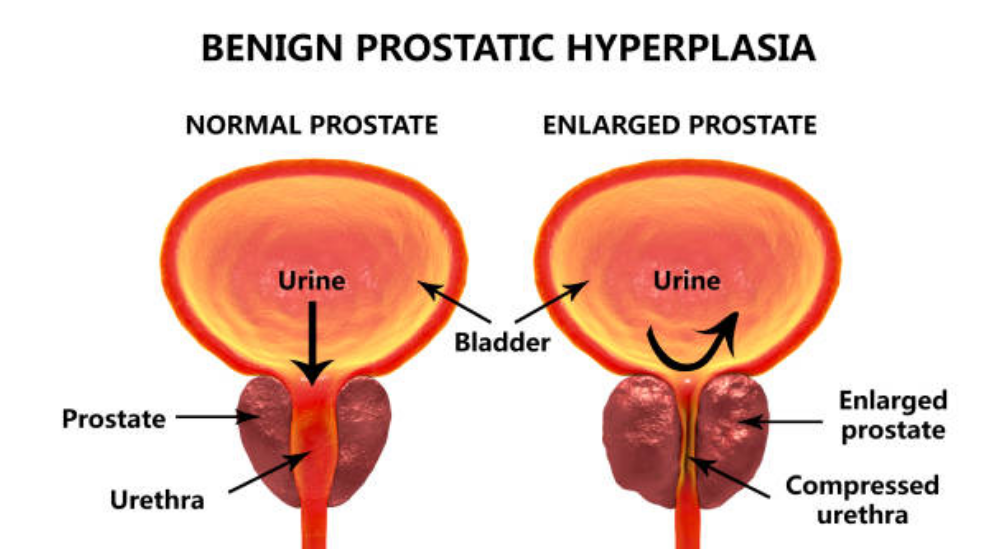 Prostatitis hiperplázia